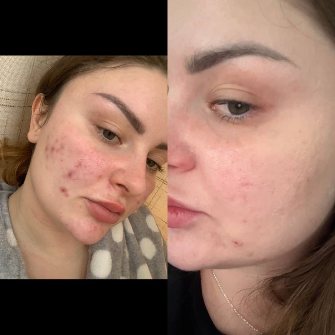 Acne treatment transformation: before photo showing active breakouts and inflammation on cheeks; after photo taken after 6 treatment sessions showing significantly clearer skin with reduced redness and improved texture